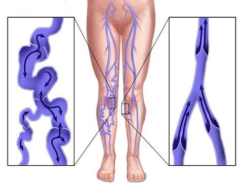 Comparison of veins affected by varicose and veins after using Veniselle