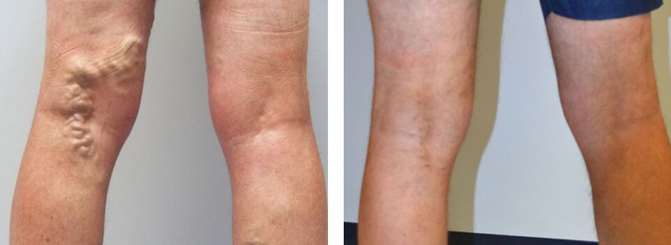 Photo before and after using Veniselle, the experience of using cream