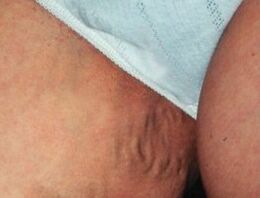 manifestations of varicose veins of the pelvis