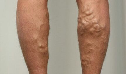 Symptoms of varicose veins