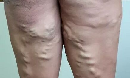 The consequences of varicose veins