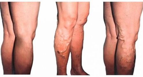 causes of varicose veins