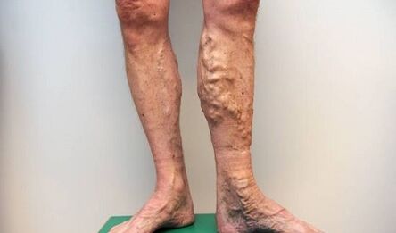 varicose veins in men