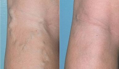 how to treat varicose veins on the legs