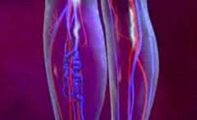 Causes and treatment of varicose veins