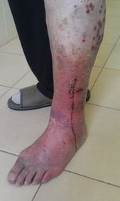Leg affected by varicose veins after hirudotherapy