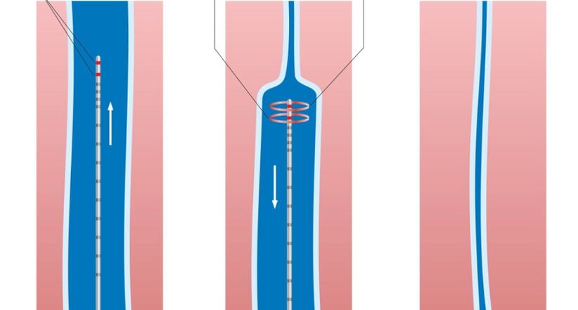 laser treatment for varicose veins on the legs