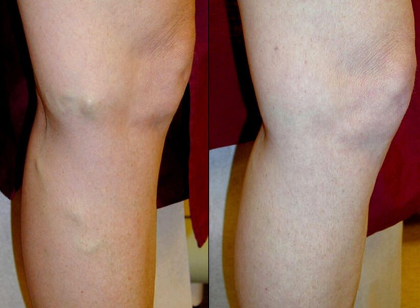methods of treating varicose veins on the legs