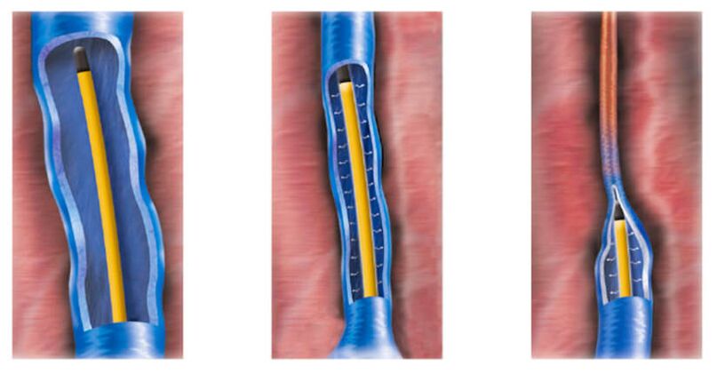 radiofrequency ablation as a method of treating varicose veins