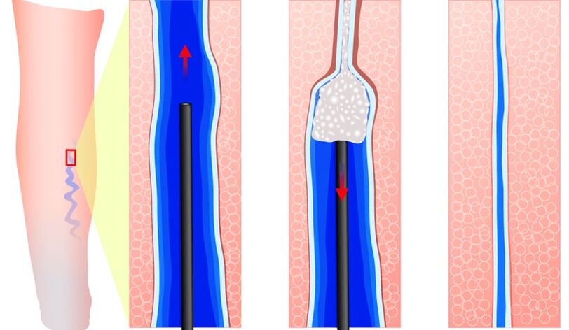 sclerotherapy as methods of treating varicose veins