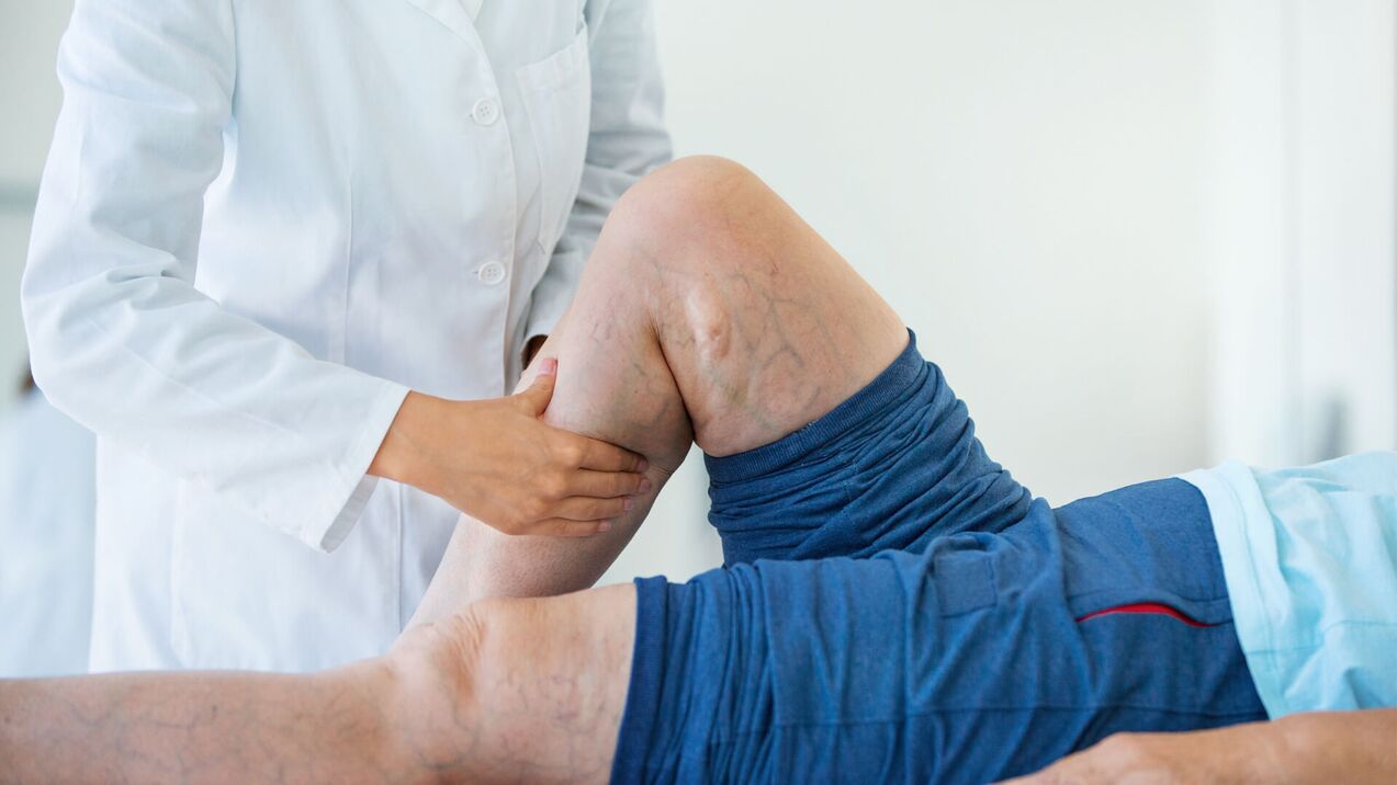How do varicose veins appear on the legs